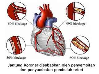 Obat Jantung Koroner ICP Capsule 