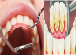 4 Cara Menghilangkan Plak Pada Gigi