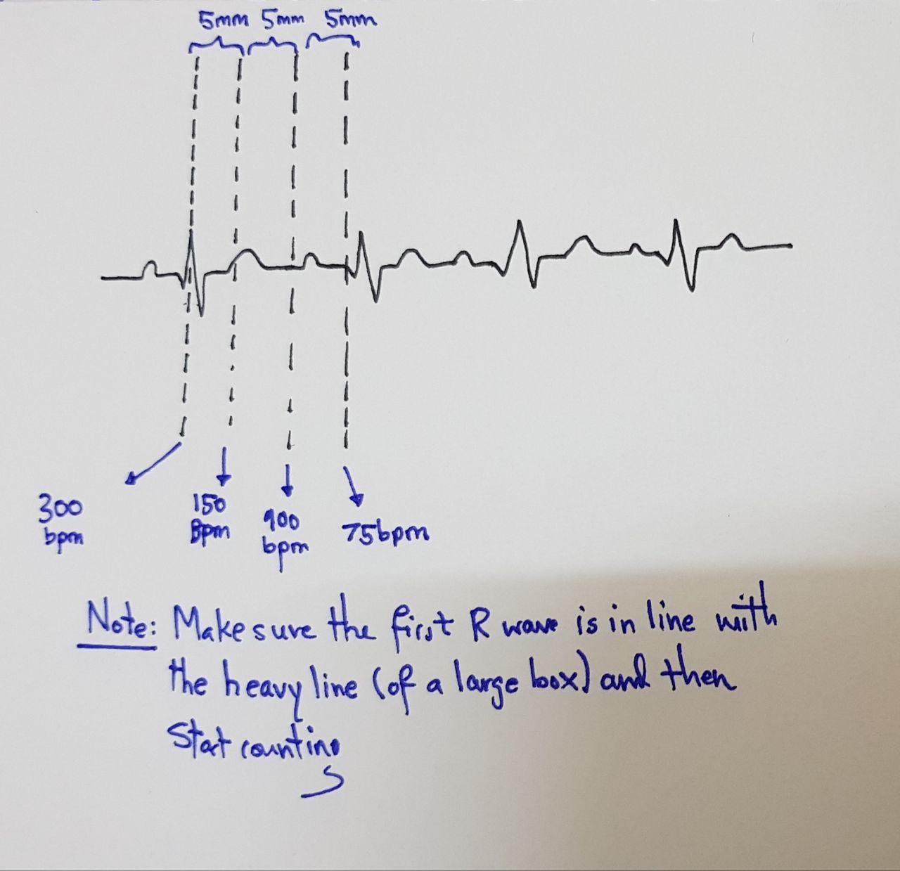 Medicowesome Mnemonics And Basics Of Ecg Interpretation