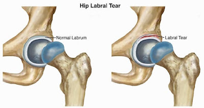 Hip Injury: Acetabular Labral Tears - El Paso Chiropractor