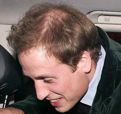 prince william hair before and after. prince william hair before and