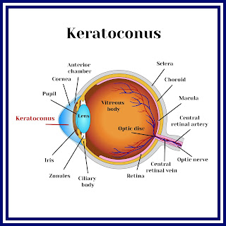 Keratoconus