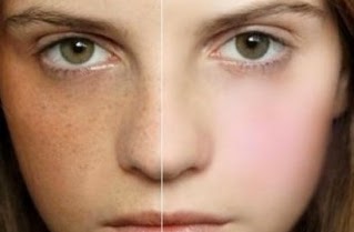 How To Bleach Or Lighten Your Freckles Skin Whitening Remedies