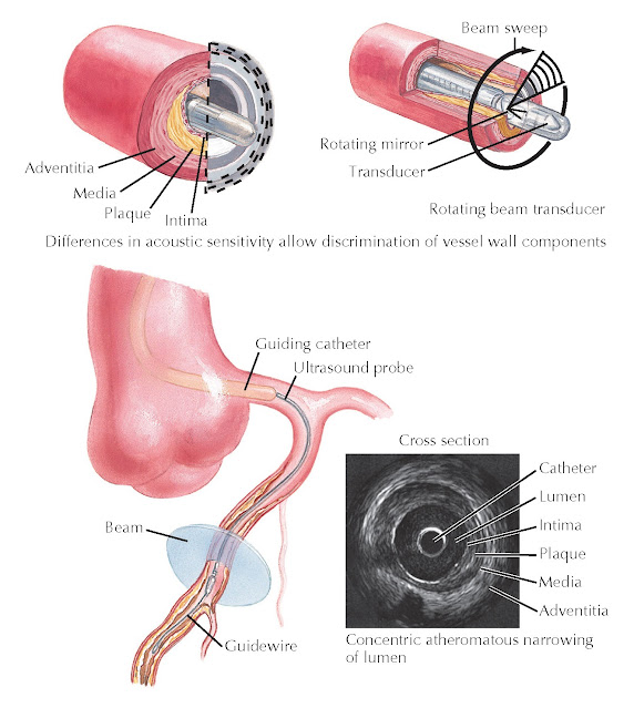 Intravascular ultrasound.