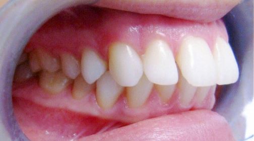 Bọc răng sứ hoàn toàn có thể khắc phục hiệu quả được những trường hợp răng hô nhẹ