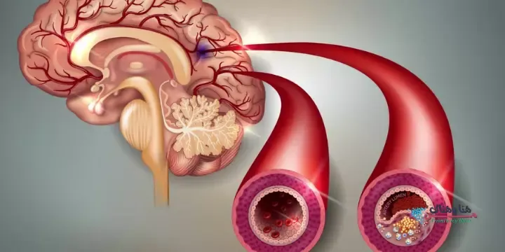 ماذا يحدث في نقل الدم للمجموعات غير المتوافقة,جلطات,الموت المفاجئ,الشلل