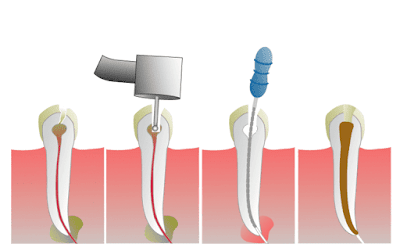 Endodontik