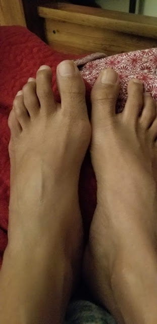 left foot bunion looks like before the surgery