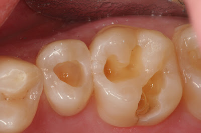 Răng cấm bị mẻ phải làm sao?