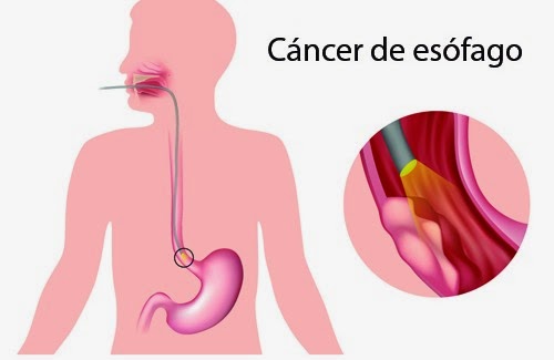 Cancer de esófago: síntomas y tratamientos