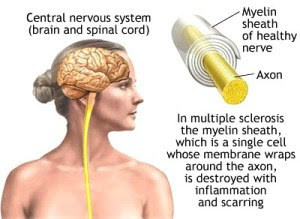 Penyakit Multiple Sclerosis Lebih Mudah Menyerang Wanita