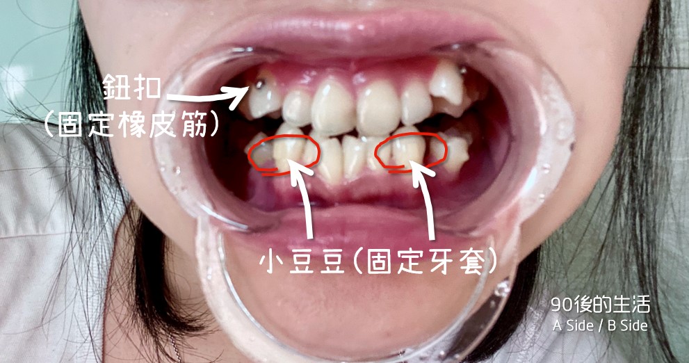 隱形牙套矯正