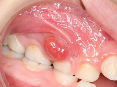 Điều trị áp xe chân răng tại nha khoa