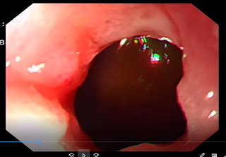 pyloric ring, anatomically opened but functionally closed