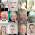 Albinism Is World Wide