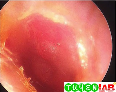 Acute otitis media in the left ear of a 15-month-old patient with marked erythema and bulging of the tympanic membrane