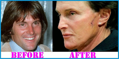 Bruce Jenner Plastic Surgery before and after
