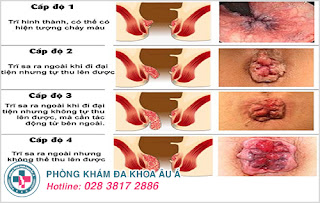 Dấu hiệu nhận biết bệnh trĩ nội