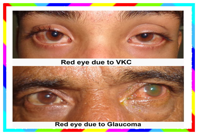 Acute congestive glaucoma