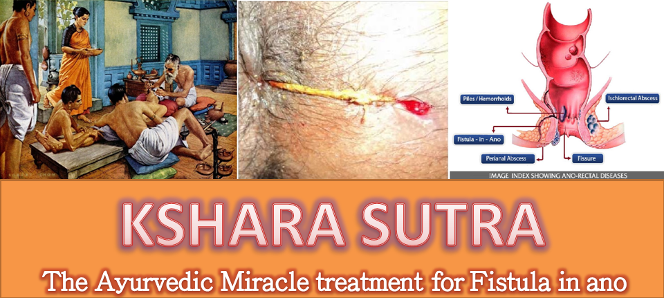 Kshara Sutra - The Ayurvedic Miracle treatment for Fistula in ano