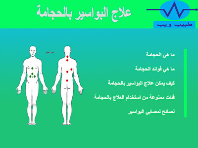 علاج البواسير بالحجامة