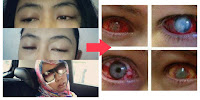 Nggak Mau Kaya Gini Kan Matanya..?? Harap Hati - Hati Saat menggunakan Softlens..!! Bantu Share !!