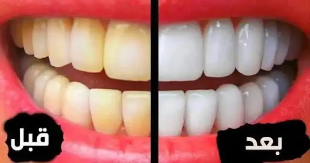 وصفة طبيعية لتبييض فوري للأسنان وإزالة الجير المتراكم لسنوات فيها