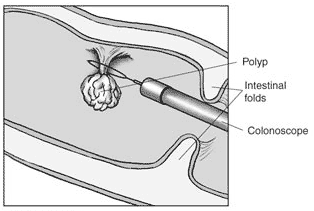 Illustration of Polyp being removed by a Colonoscope