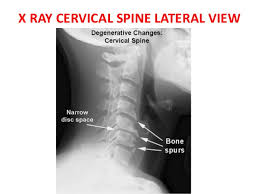 cervical spondylosis X-ray