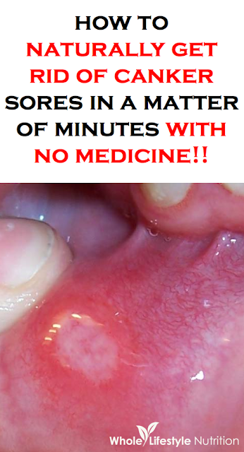 HOW TO NATURALLY GET RID OF CANKER SORES IN MINUTES WITH NO MEDICINE!
