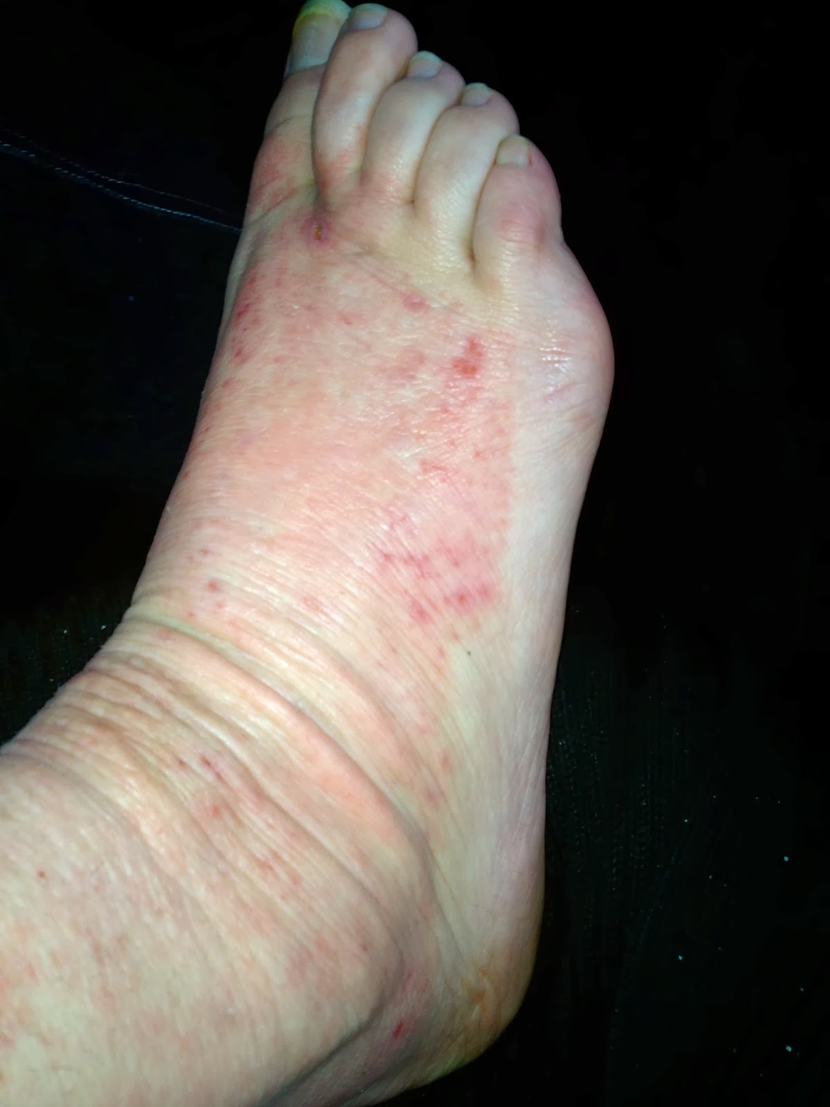 Scratching the Surface of Topical Steroid Withdrawal: Day 128