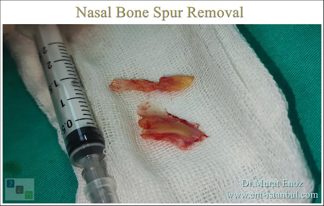 Nasal Bone Spur,septal spur,Contact Point Headaches,Ossified Overhang,Bony Nasal Septal Spur,
