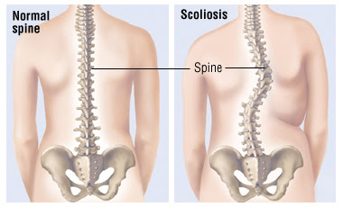 Scoliosis