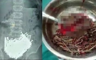 Doctors Remove Over 200 NAILS From 15-Year Old Boy's Stomach