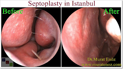 Septoplasty in Istanbul - The Nasal Septum - Deviated Septum - Septoplasty Definition - Symptoms of Deviated Septum - Septoplasty Price Istanbul - Septoplasty in Turkey - How Much Does Deviated Septum Repair? - Caudal Septoplasty - Septoplasty in Turkey - Septoplasty Turkey - Cost of Septoplasty - Symptoms of Nasal Septum Deviation - Septoplasty Operation - Diagnosis of Deviated Nasal Septum - Diagnosis of Deviated Septum - Differential Diagnosis of Deviated Nasal Septum - Nasal septal deviation - NSD - Types of deviated septum - Normal nasal septum - "C"- shaped deviation of the septum - "S"- shaped deviation of the septum - Dislocation of septal cartilage - Subluxation of septal cartilage - Dislocation of the caudal septum - Caudal septum deviation - Septal spur - Thickening of the nasal septum - Septum deviasyonu türleri - Nasal septal spur - Bone spur formation of the septum - Anterior dislocation of septum - Caudal dislocation of septum - How Much Does a Septoplasty Cost in Istanbul? - Septoplasty Operation Technique - Surgcal Technique of Septoplasty Operation - Nasal Splint Removal Video - Silicone Nasal Splints Advantages - Post-Operative Instruction For Septoplasty - Risks And Complications Of Septoplasty - Risks And Complications Of Deviated Septum Surgery - Nasal Septal Perforation - Nasal Septum Perforation - Nasal Septum Perforation Symptoms - Nasal Septum Perforation Diagnosis - Nasal Septum Perforation Treatment - Nasal Septum Perforation Closure - Nasal Surgical Repair Of Nasal Septum Perforation - Nasal Adhesion (Synechia) - Nasal Tip Ptosis - Saddle Nose Deformity - Saddle Nose Correction - Positive Health Effects Of Deviated Nasal Septum Surgery - Positive Health Effects Of Septoplasty Surgery - Functions of The Nose - Contact Point Headaches