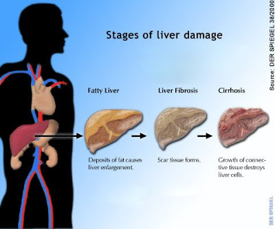 Exercises Remove Belly  on My Advise Is At Least Once A Year  Have Your Liver Checked With Blood