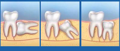 Điều trị viêm chân răng khôn bằng cách nào