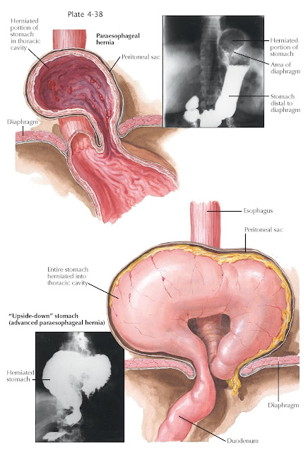 PARAESOPHAGEAL HERNIA AND GASTRIC VOLVULUS