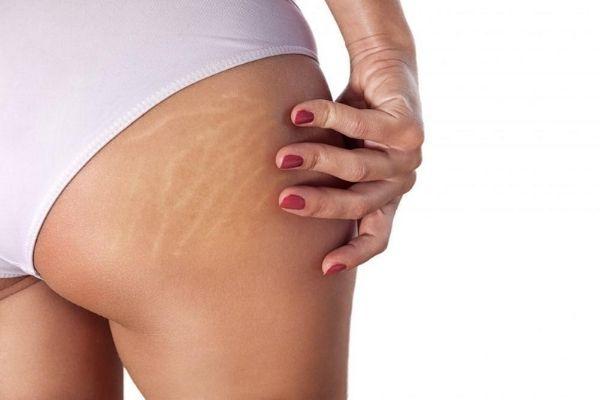 Causes of stretch marks, beauty tips for women