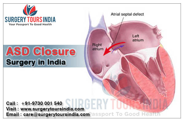 ASD Closure Surgery India