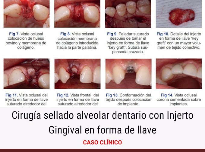 CASO CLÍNICO: Cirugía sellado alveolar dentario con Injerto Gingival en forma de llave