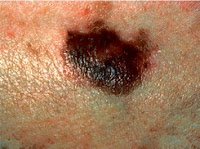 skin moles cancer