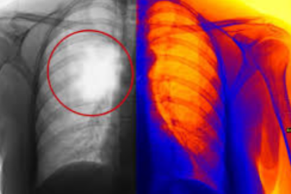 Mesothelioma Cancer Symptoms for Your Informations