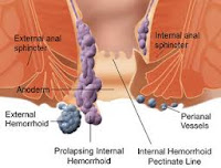 Penyebab Tanda Gejala Ambien Hemoroid 