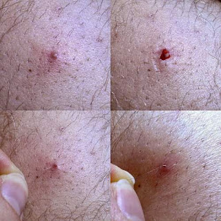 image of ingrown hair