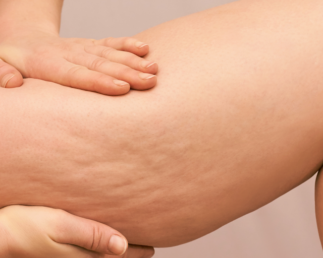 Découvrez ces 7 aliments qui donnent de la cellulite
