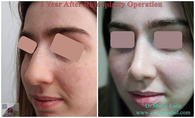 Rhinoplasty Operation in Istanbul ,Nose Job in Turkey,Nose aesthetic,1 year after rhinoplasty