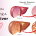 What is Fatty Liver (Steatosis)?