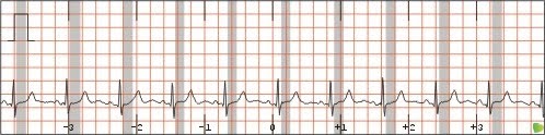 Segmento ST en Electro-CardioGrama