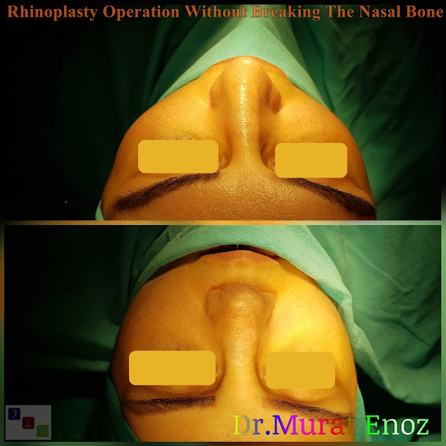 Nose job without bone broken,Rhinoplasty Without Breaking The Nasal Bone in Istanbul,